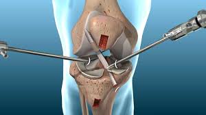 Ligament Reconstruction